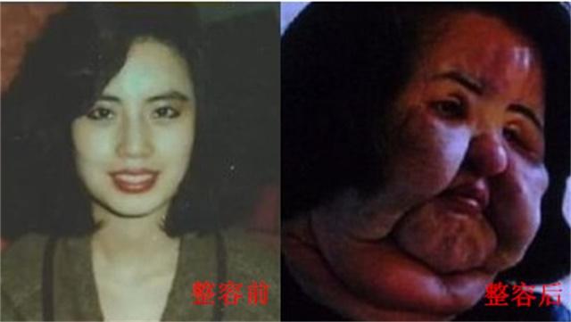 最新整容失败案例引发的深度反思与探讨